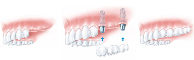 implant-several-missing-teeth